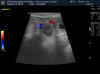 ultraschall_ischyma_q2.jpg (66914 Byte)